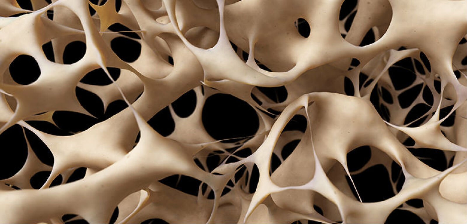 Ousting Osteoporosis and How to Prevent